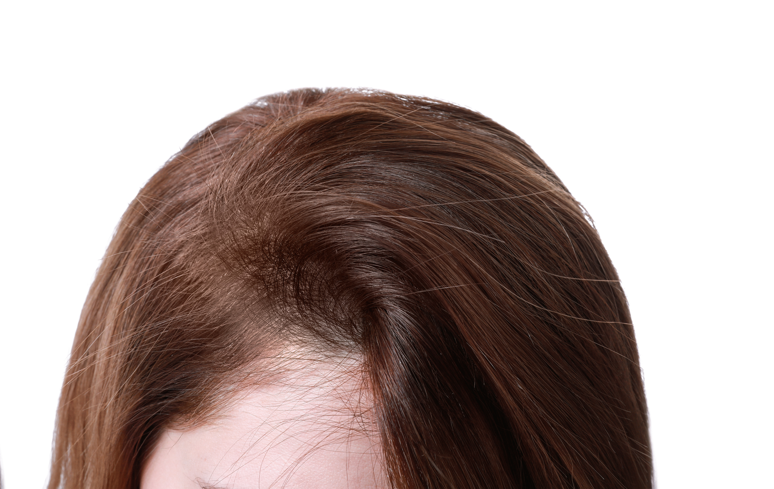 Hair Loss After scaled