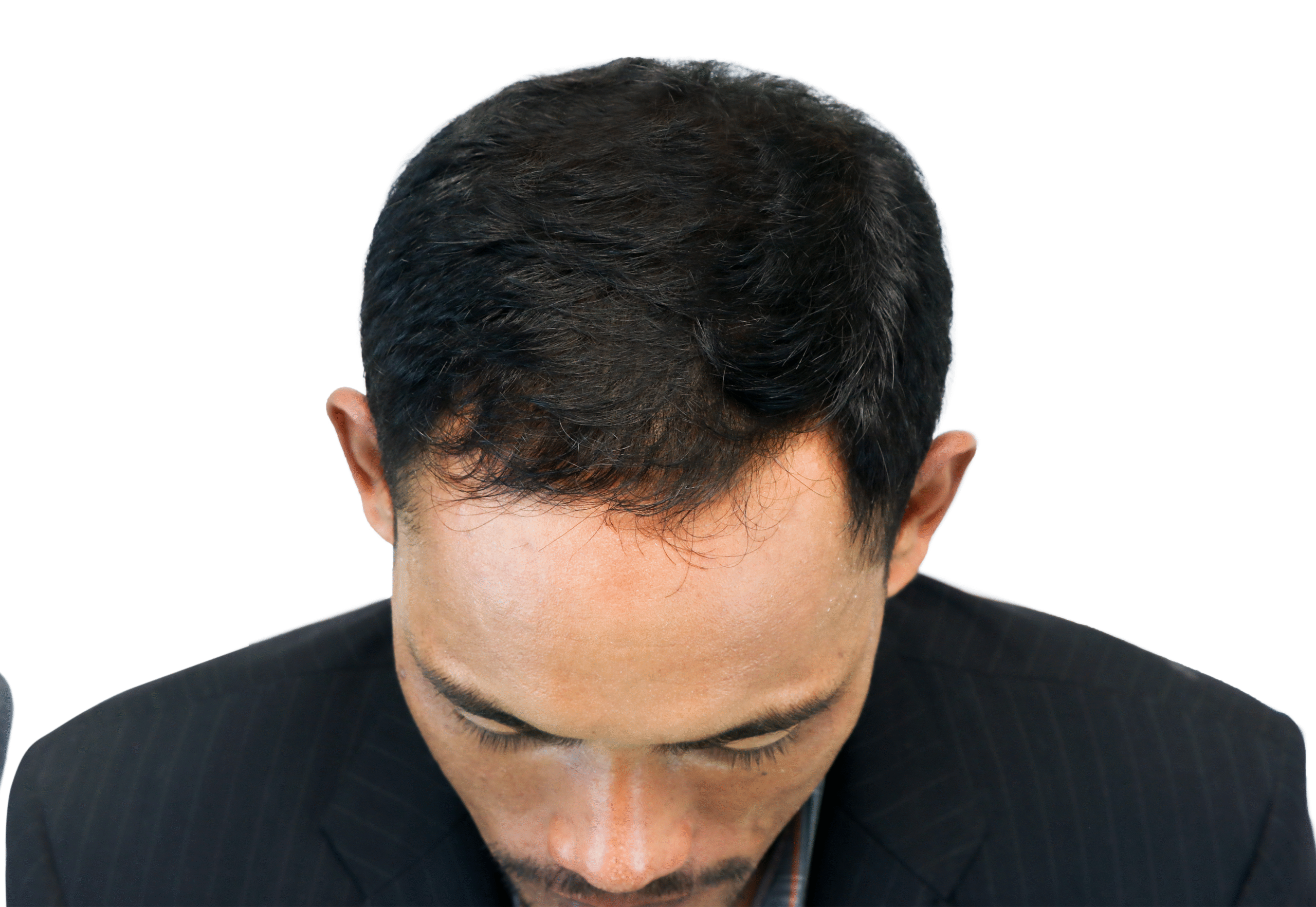 after hair scaled