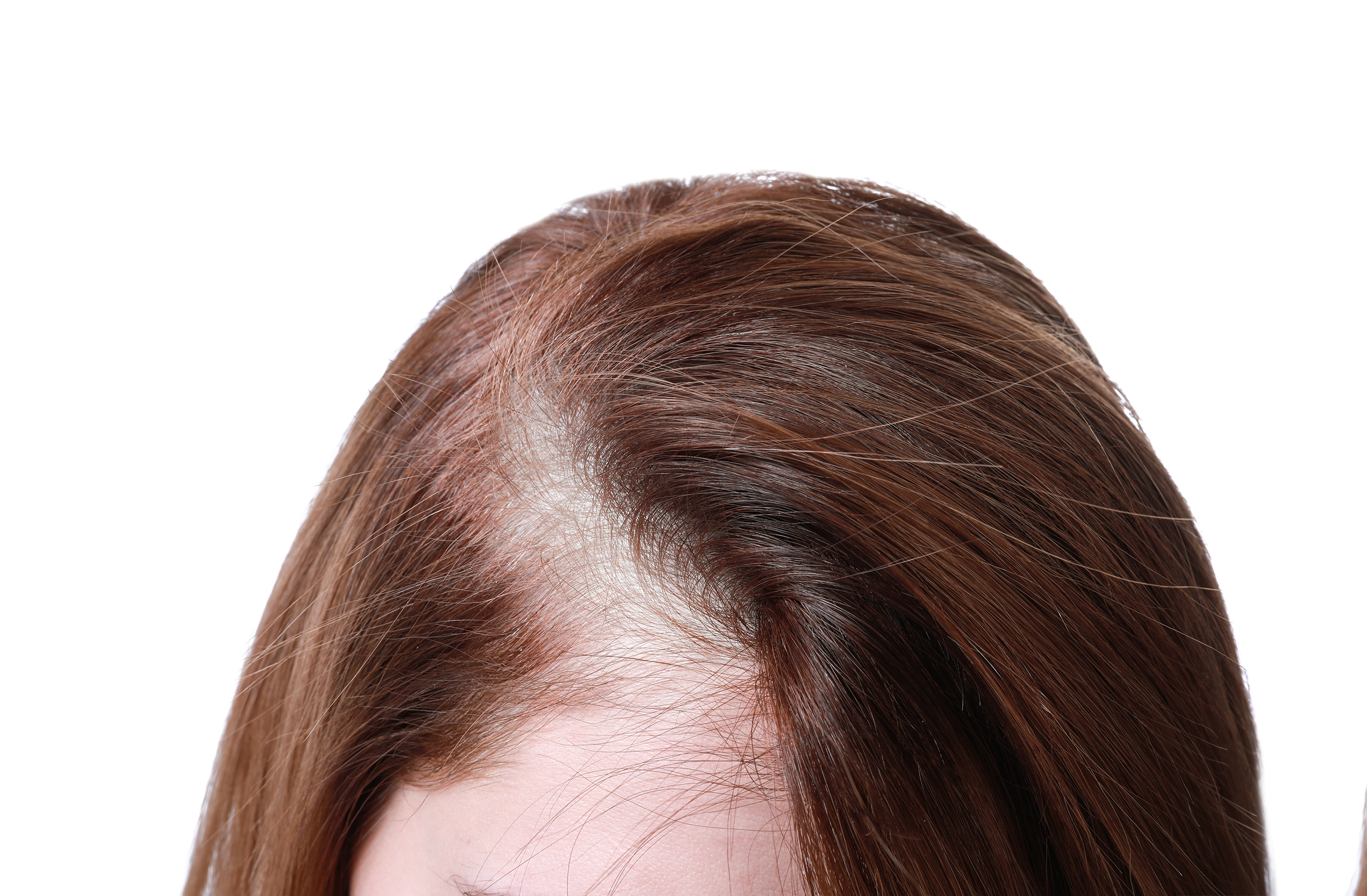 hairlossbefore5